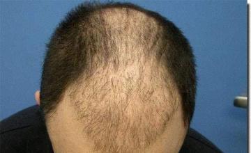 Hair restoration procedure results