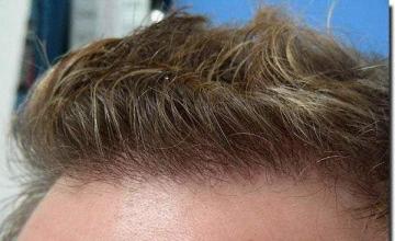 Hair restoration procedure results