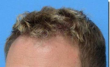 Hair restoration procedure results