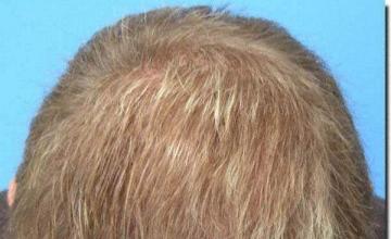 Hair restoration procedure results