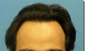 Hair restoration procedure results