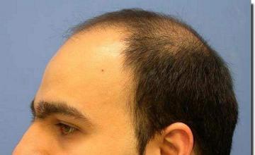 Hair restoration procedure results