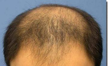 Hair restoration procedure results