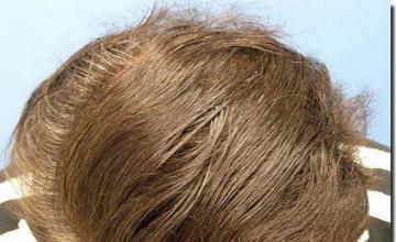 Hair restoration procedure results