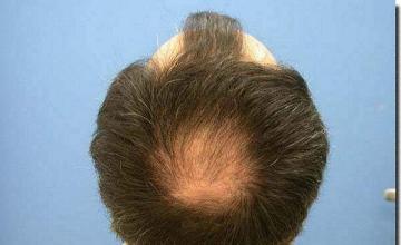 Hair restoration procedure results