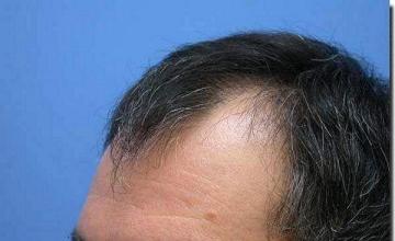 Hair restoration procedure results