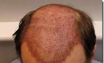 Hair restoration procedure results