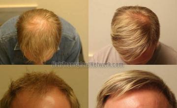 Hair transplantation surgery before and after images