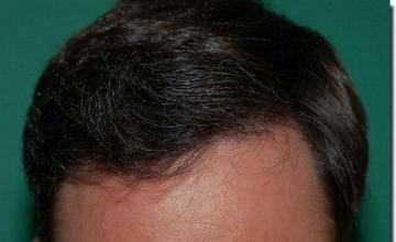 Hair restoration procedure results