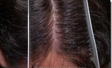 Hair restoration procedure results