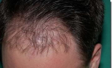 Hair restoration procedure results