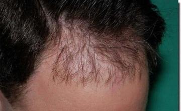 Hair restoration procedure results