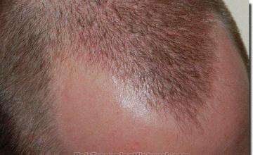 Hair restoration procedure results