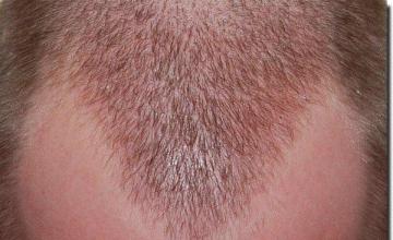 Hair restoration procedure results