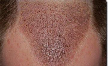 Hair restoration procedure results