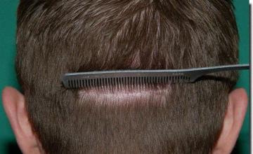 Hair restoration procedure results