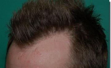 Hair restoration procedure results