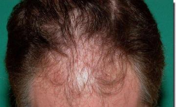 Hair restoration procedure results