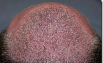 Hair restoration procedure results