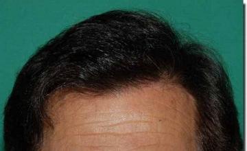 Hair restoration procedure results