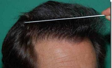 Hair restoration procedure results