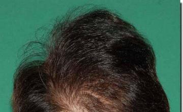 Hair restoration procedure results