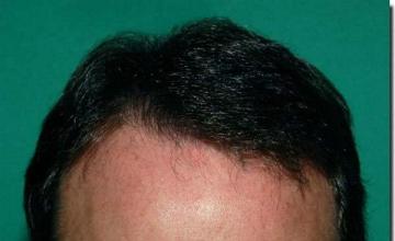 Hair restoration procedure results