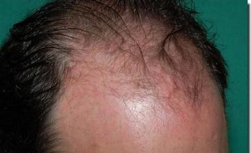 Hair restoration procedure results