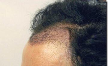 Hair restoration procedure results