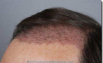 Hair restoration procedure results