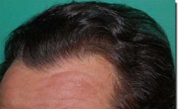 Hair restoration procedure results