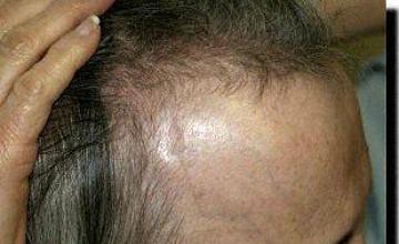 Hair restoration procedure results