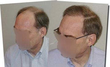 Hair restoration procedure results