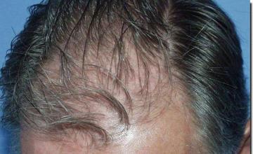 Hair restoration procedure results