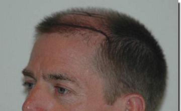 Hair restoration procedure results