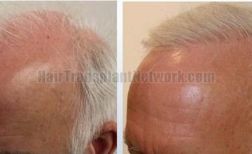 Left view before and after hair transplant surgery