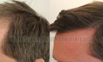 Left view before and after hair transplant surgery