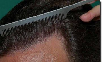 Hair restoration procedure results