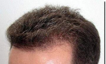 Hair restoration procedure results