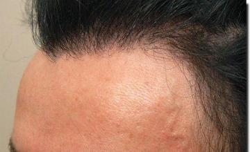 Hair restoration procedure results