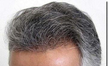 Hair restoration procedure results