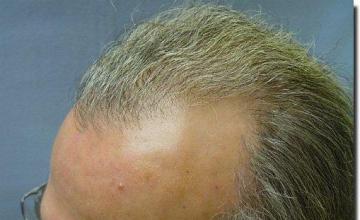 Hair restoration procedure results