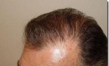 Hair restoration procedure results