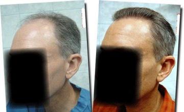 Hair restoration procedure results