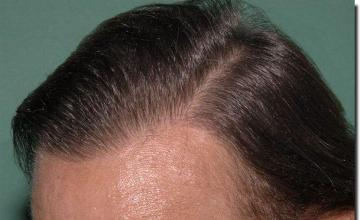 Hair restoration procedure results