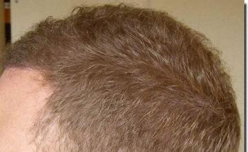 Hair restoration procedure results