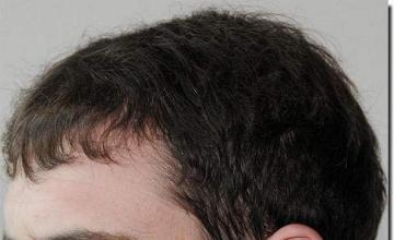 Hair restoration procedure results