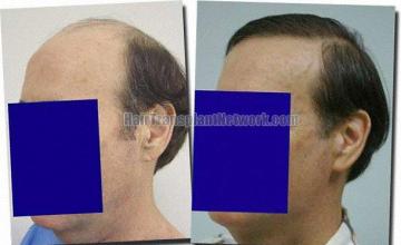 Hair restoration procedure results