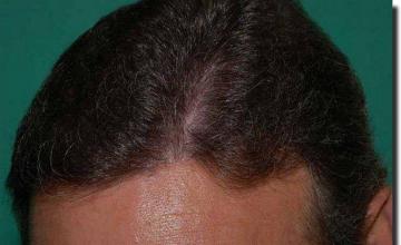 Hair restoration procedure results