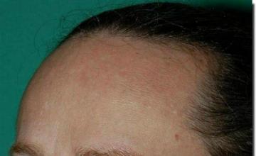 Hair restoration procedure results